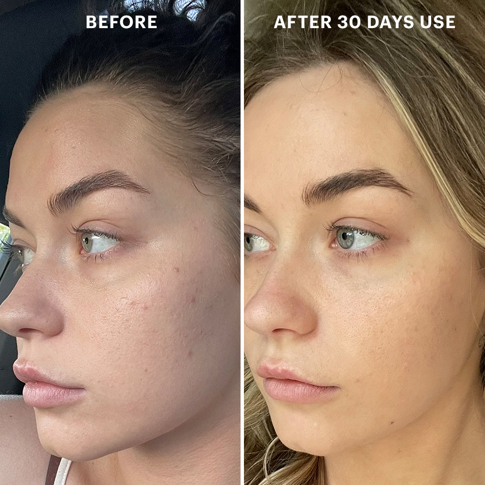 Side-by-side: LEFT — BEFORE; RIGHT — AFTER 30 DAYS USE; same woman's cheek showing reduced redness and smoother texture.