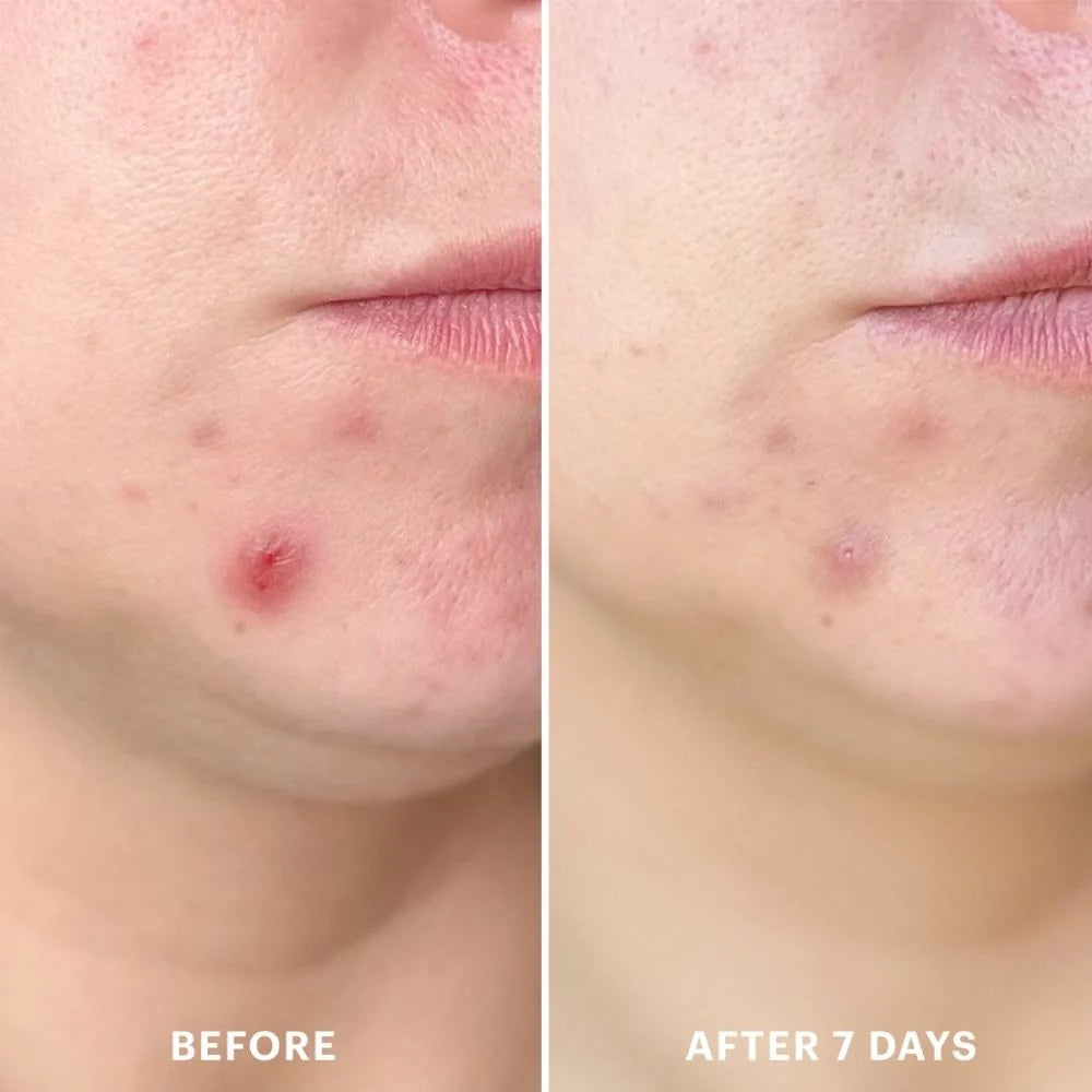 Close-up of lower cheek and chin showing a red pimple LEFT (BEFORE) and reduced inflammation RIGHT (AFTER 7 DAYS)